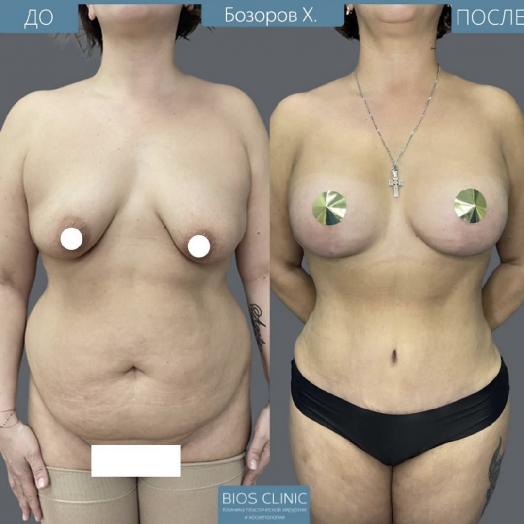 увеличение груди с вертикальной подтяжкой фотография 1