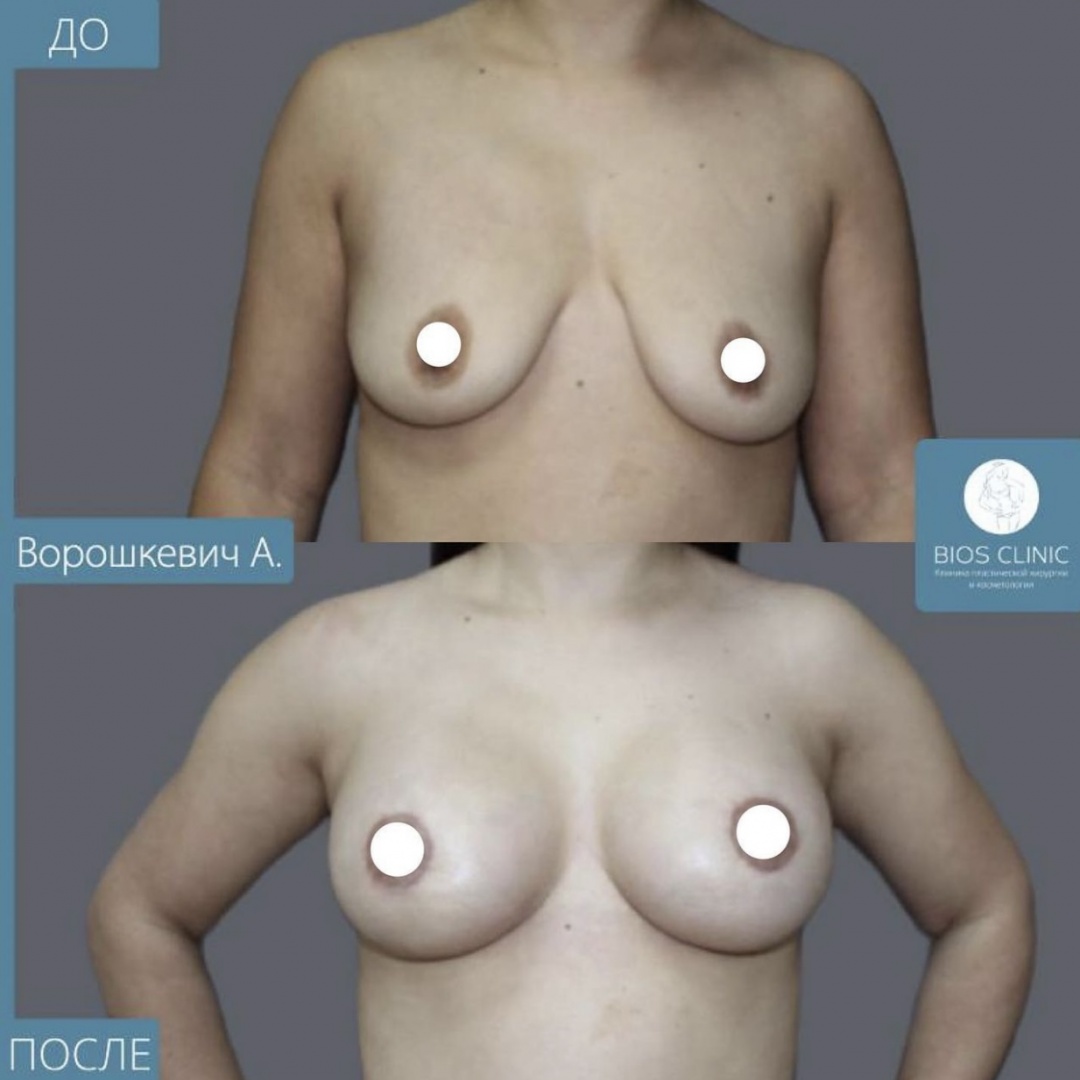 Увеличение груди с периареолярной подтяжкой фотография 3