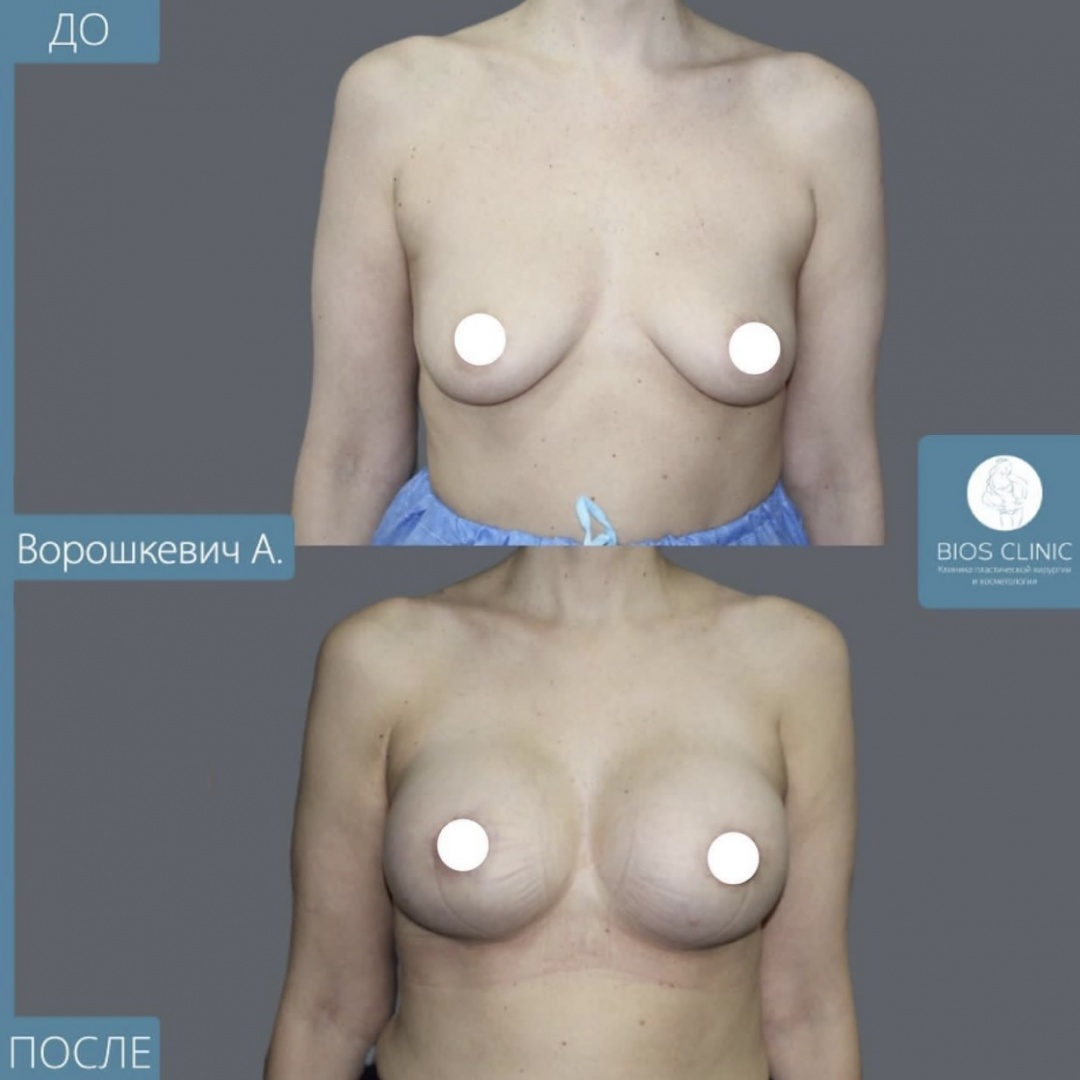 Увеличение груди с периареолярной подтяжкой фотография 3