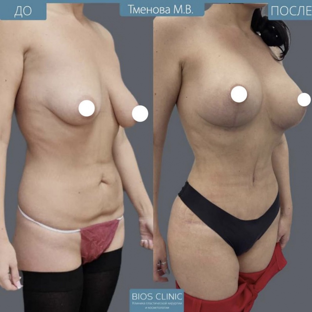 Увеличение груди + подтяжка Т образная фотография 2