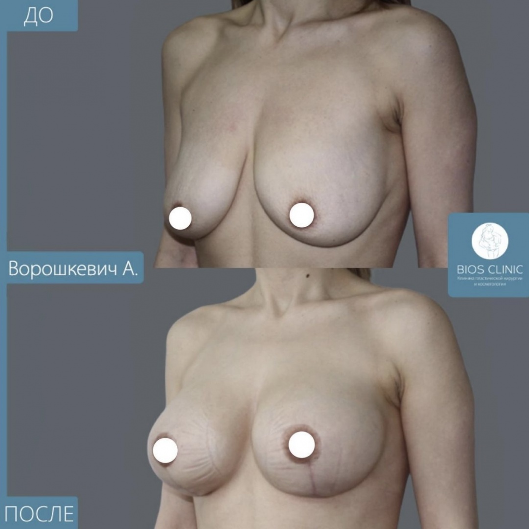 Увеличение груди + подтяжка Т образная фотография 3