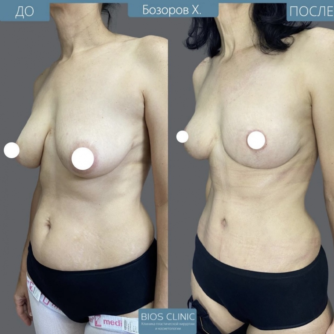 Подтяжка груди с эффектом импланта, абдоминопластика и липосакция боков фотография 2