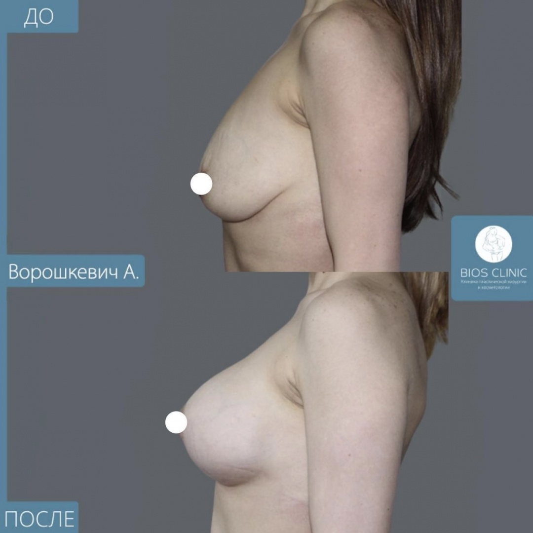 Увеличение груди + подтяжка Т образная