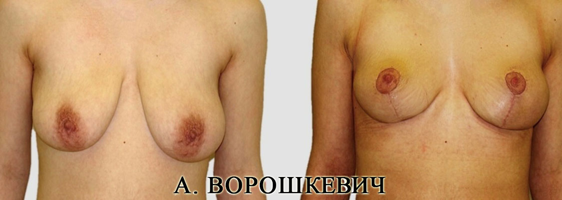 Результат подтяжки груди, мастопесии 11