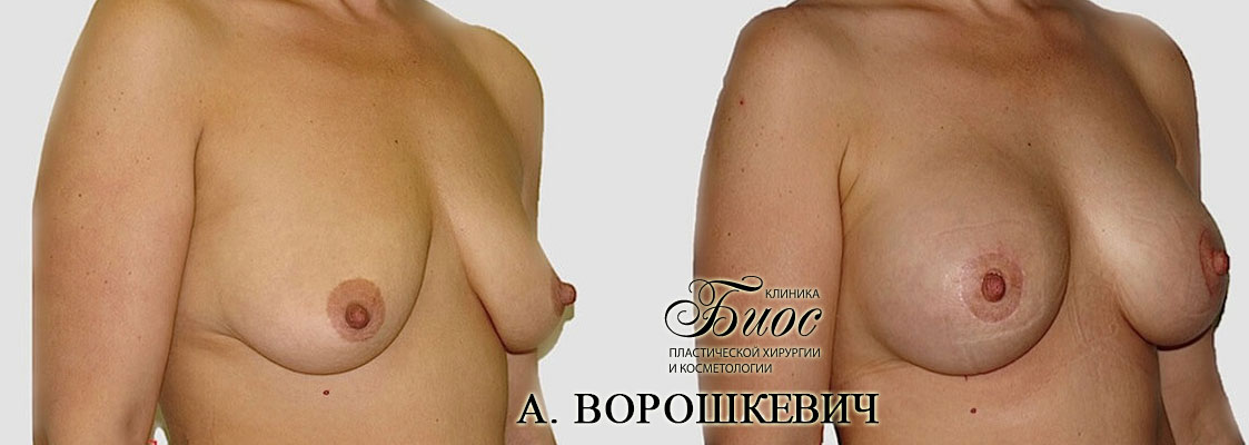Результат подтяжки груди, мастопесии 13