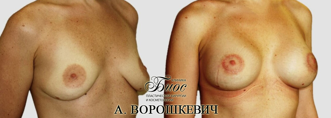 Результат подтяжки груди, мастопесии 21
