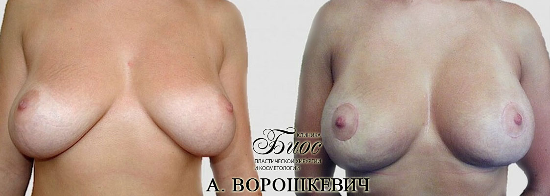 Результат подтяжки груди, мастопесии 4