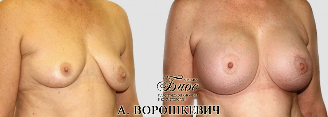 Результат подтяжки груди, мастопесии 6