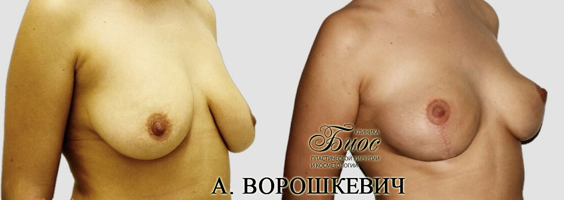Результат подтяжки груди, мастопесии 9