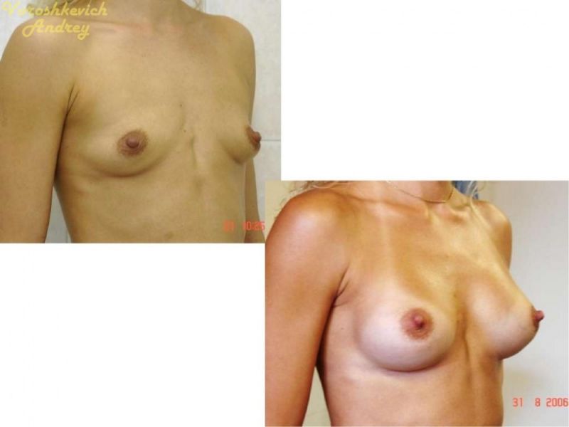 Результат операции увеличение груди 1