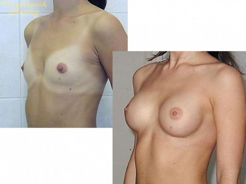 Результат операции увеличение груди 11