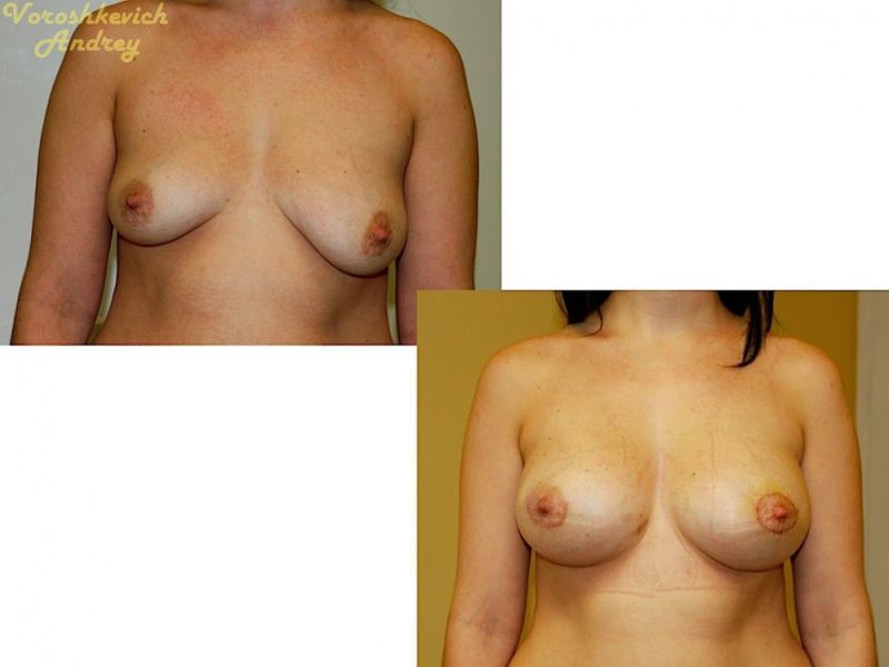 Результат операции увеличение груди 4