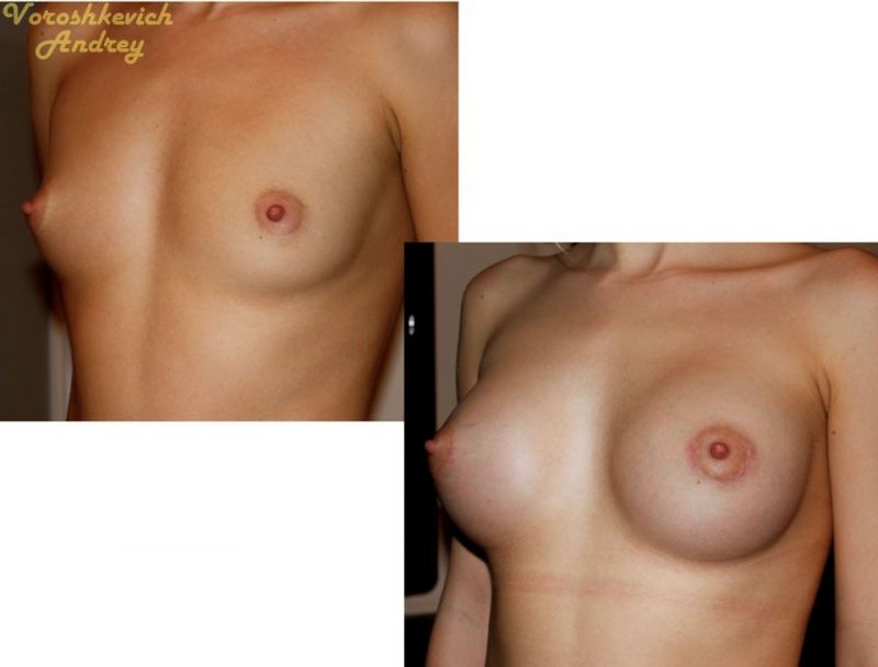 Результат операции увеличение груди 8
