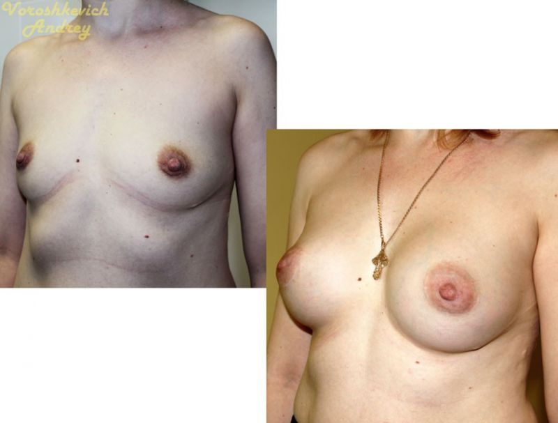 Результат операции увеличение груди 9
