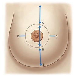 Периареолярная мастопексия показана при отсутствии возможности установить импланты