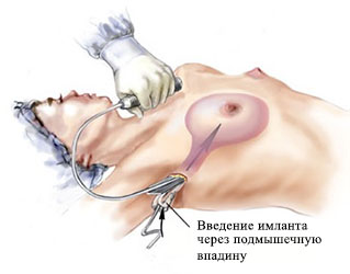 эндоскопическая подтяжка груди позволяет подтянуть обвисшую грудь небольшого размера