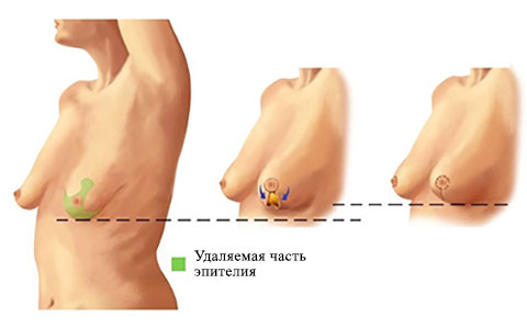 Якорная подтяжка грудных желез избавит от их провисания патологического увеличения утраты тонуса