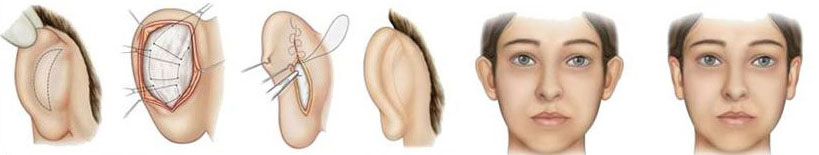 Выбирается новая форма уха с учетом антропометрических особенностей пациента