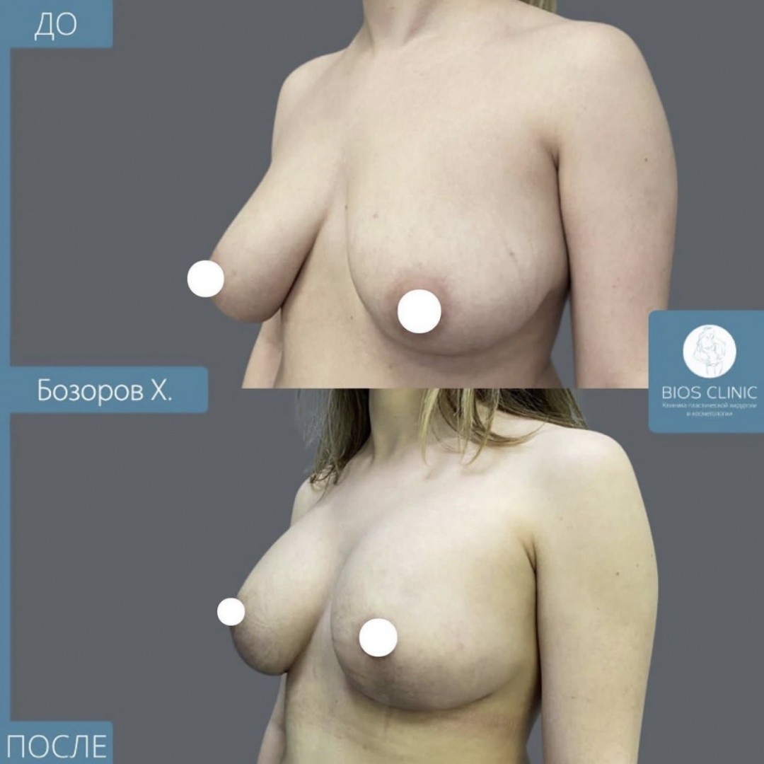 Увеличение груди с Т образной подтяжкой  фотография 1