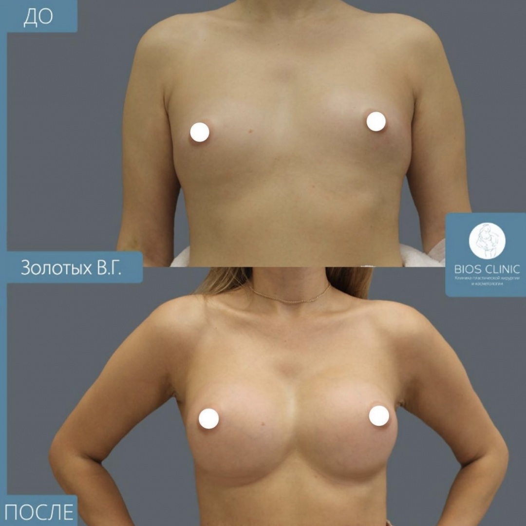 Увеличение груди через 6 месяцев фотография 2