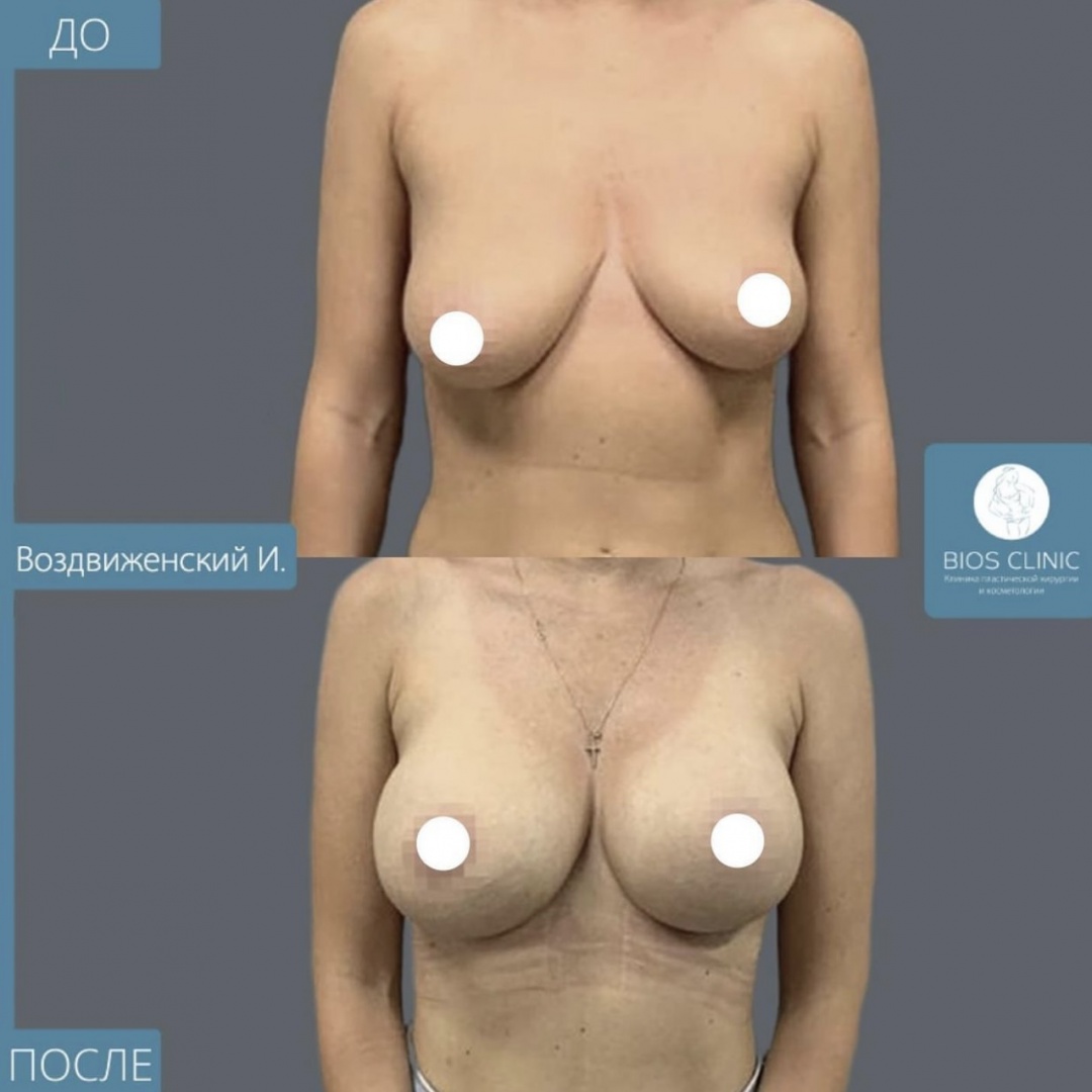 Увеличение груди с коррекцие асиметрии фотография 2