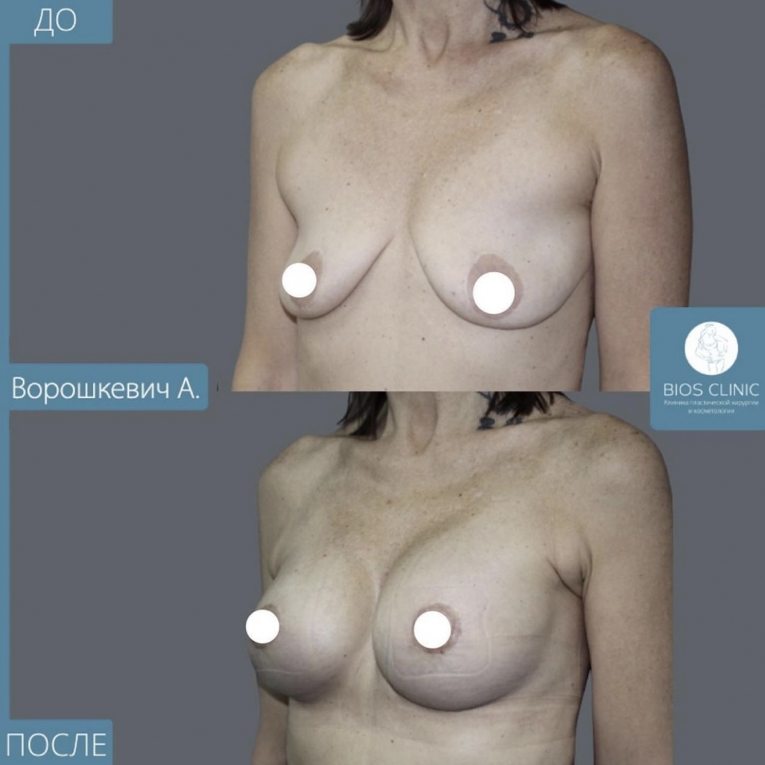 Увеличение груди фотография 3