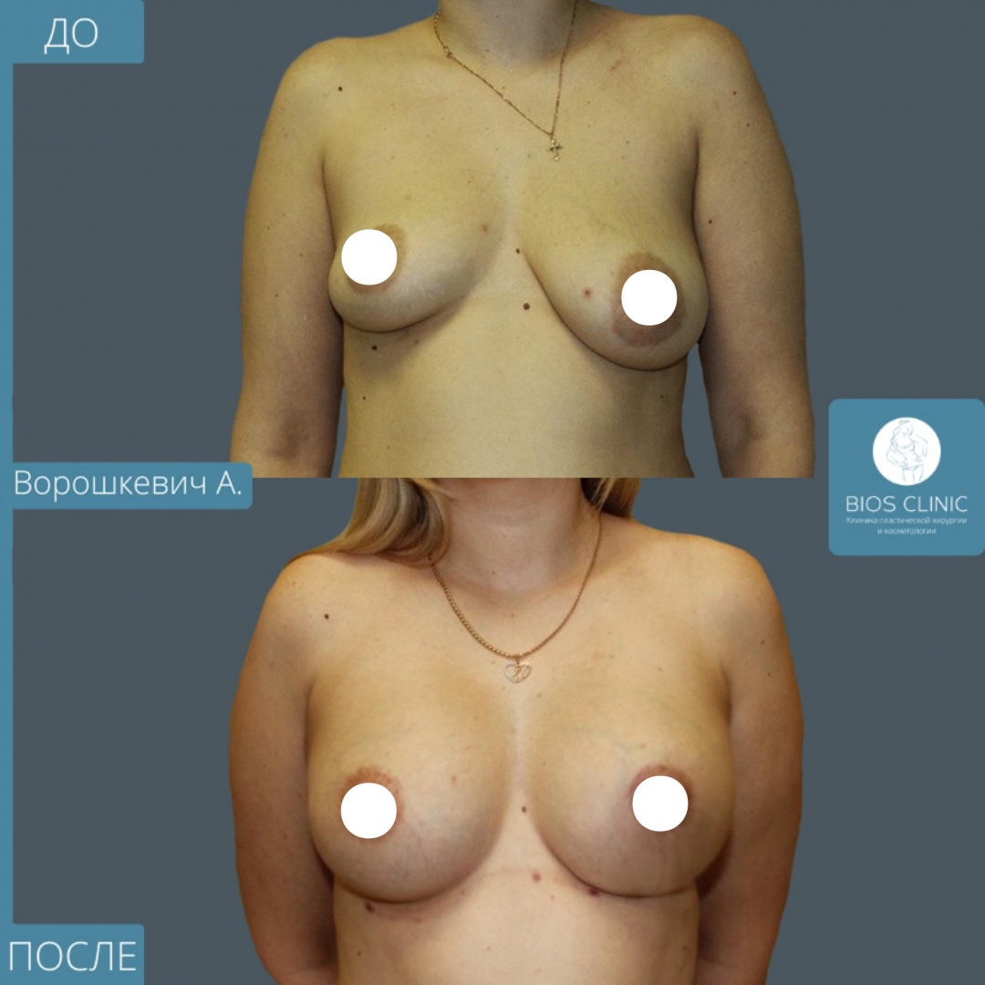 Подтяжка груди на имплантах фотография 1