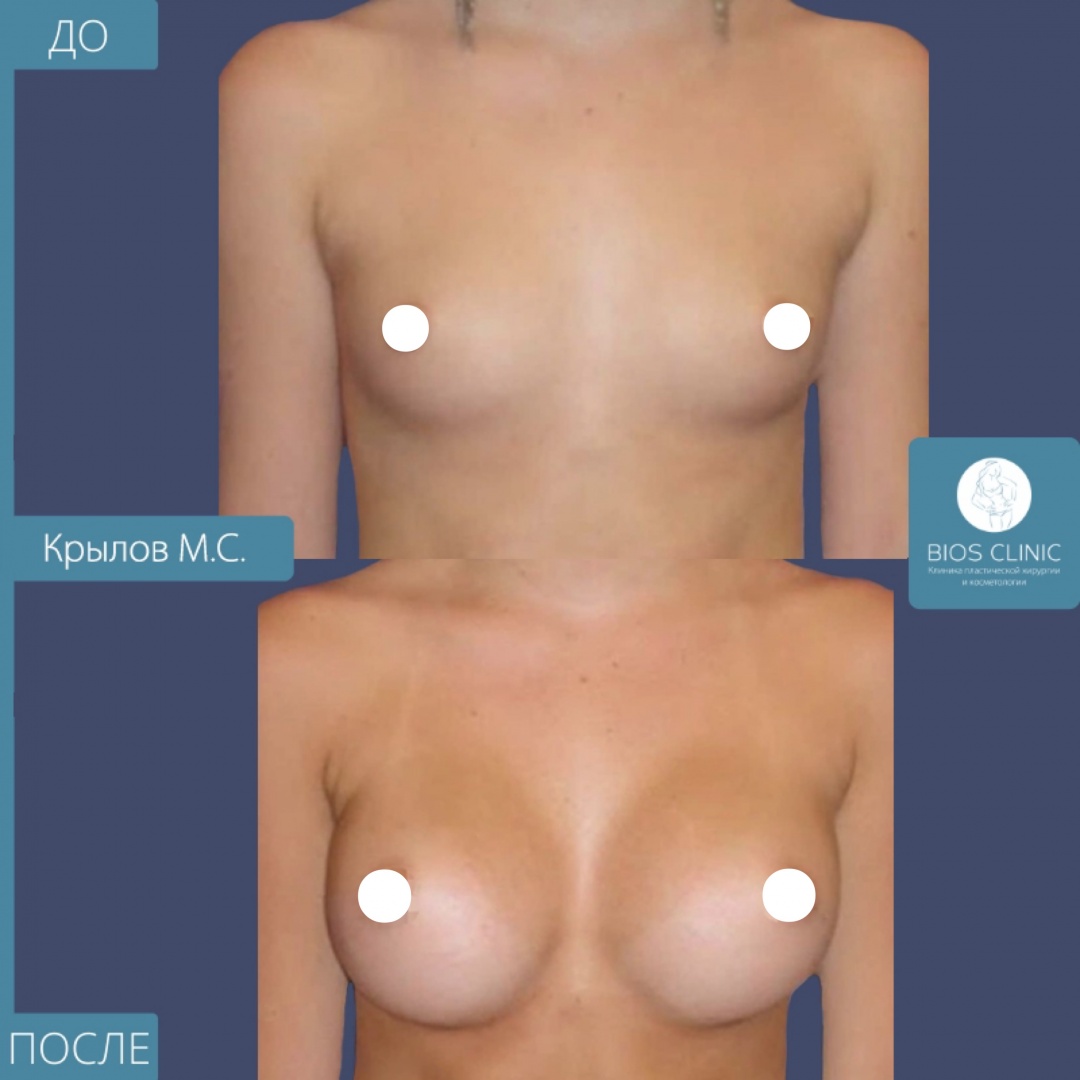 Увеличение груди круглыми имплантами 350 мл, субмаммарный доступ фотография 1
