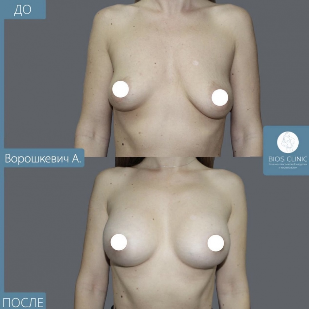 Увеличение груди с периареолярной подтяжкой
