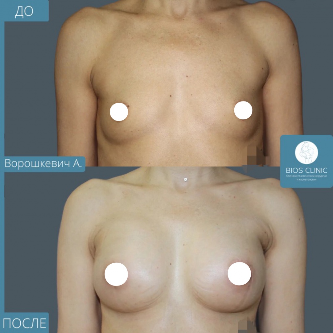 Увеличение груди эндоскопическим доступом фотография 2