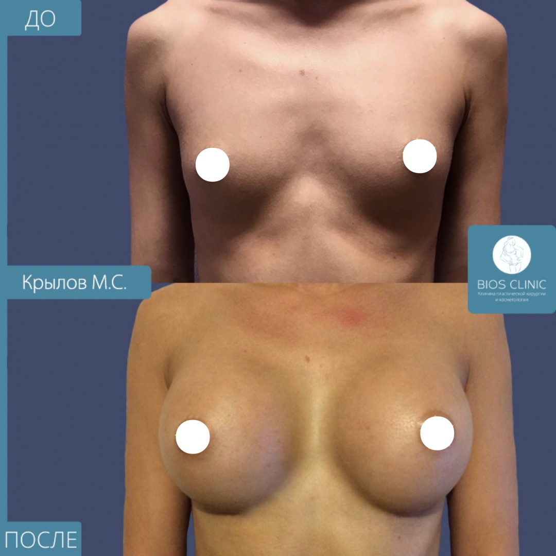 Увеличение груди сверхвысокими круглыми имплантами фотография 1