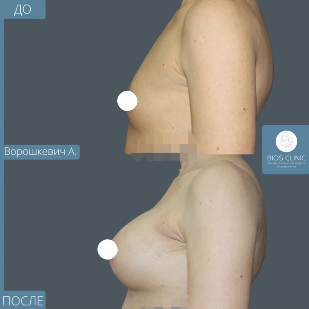 Увеличение груди через месяц фотография 1