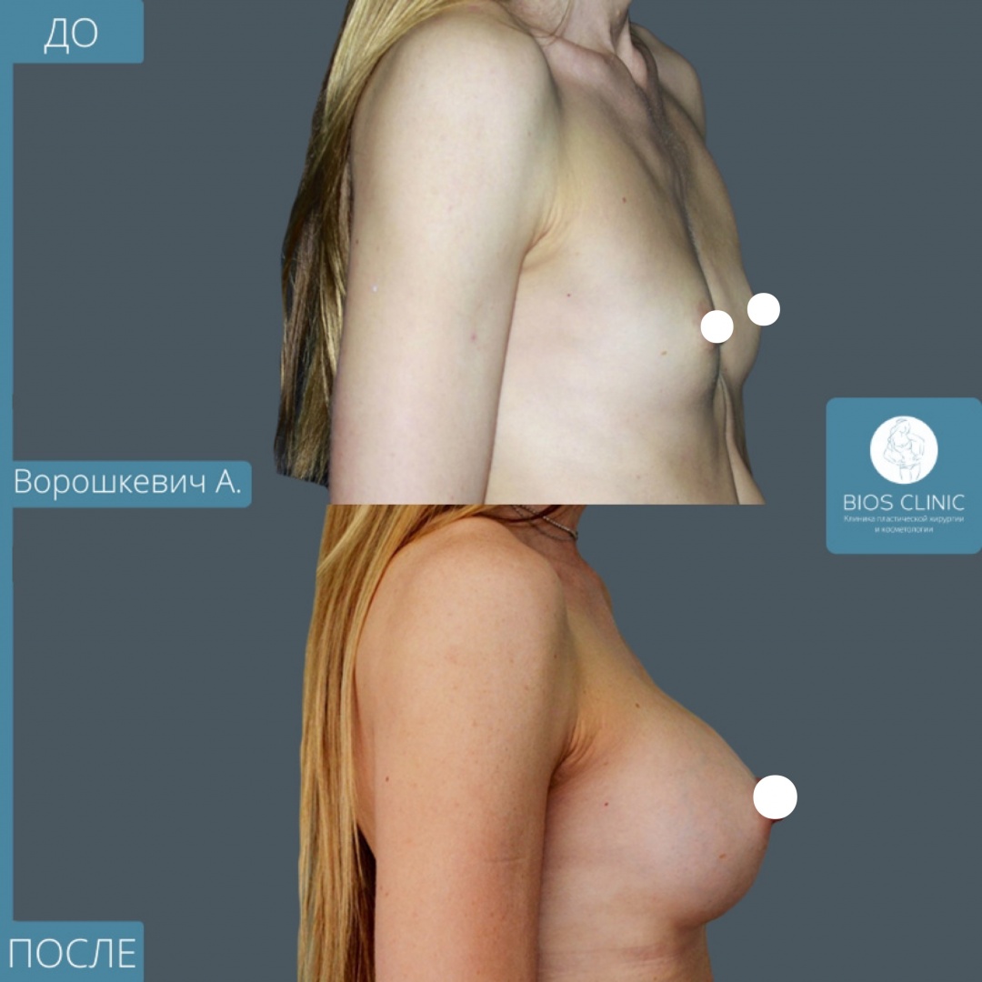 Увеличение груди фотография 3