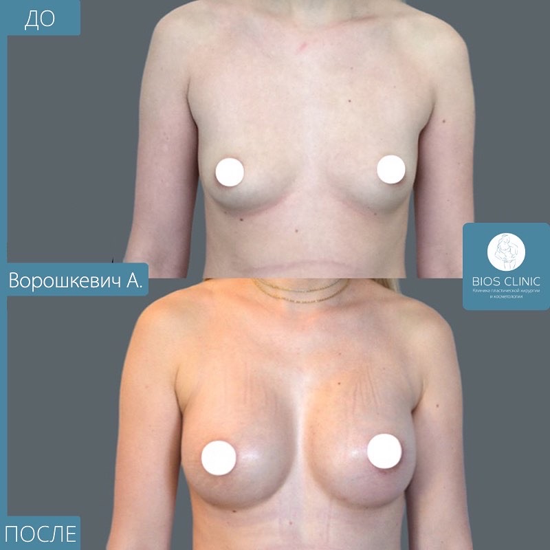 Увеличение груди анатомическими имплантам