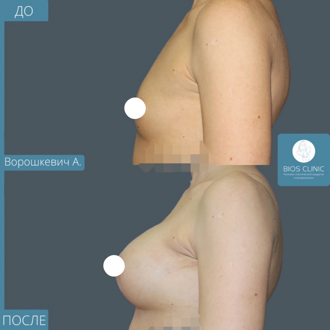 Увеличение груди эндоскопическим доступом фотография 1