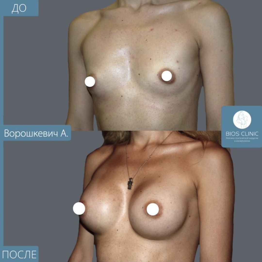 Увеличение груди фотография 1