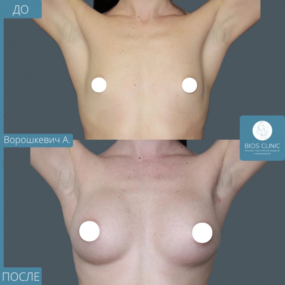 Увеличение груди эндоскопическим методом фотография 3