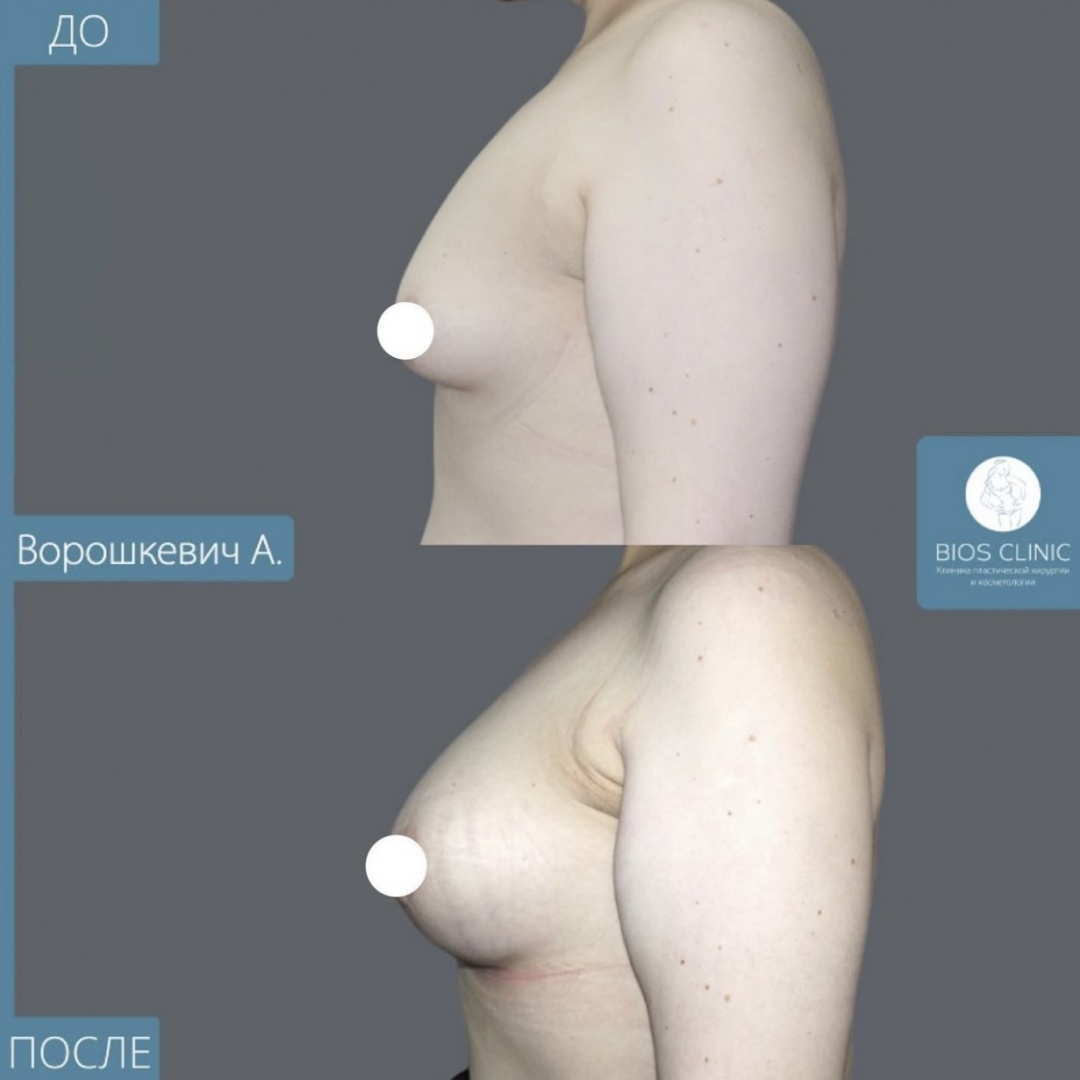 Увеличение груди  фотография 2