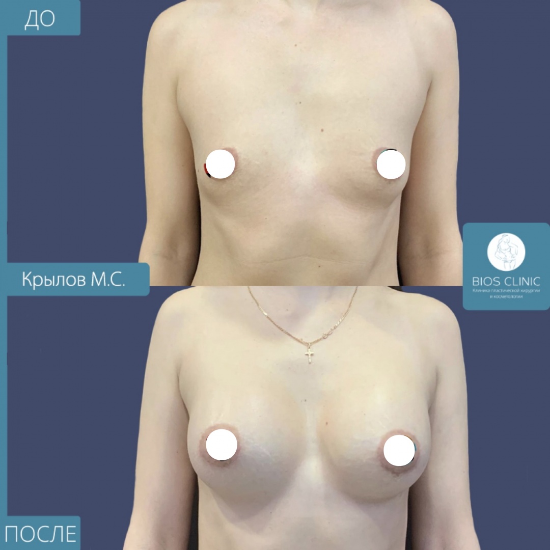 Увеличение груди круглыми имплантами, ареолярный доступ фотография 1