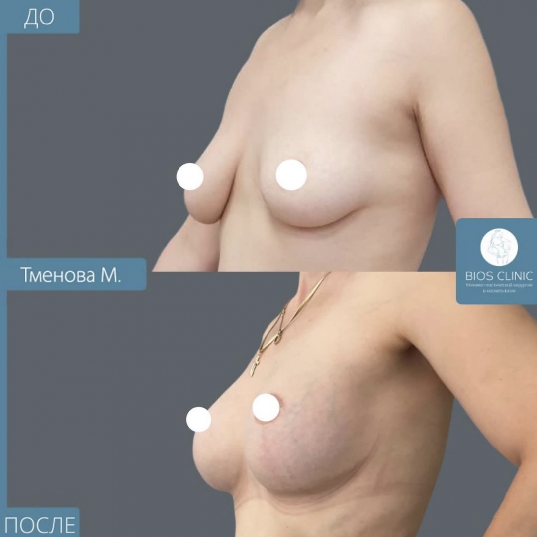 Увеличение груди с Т образной подтяжкой  фотография 1