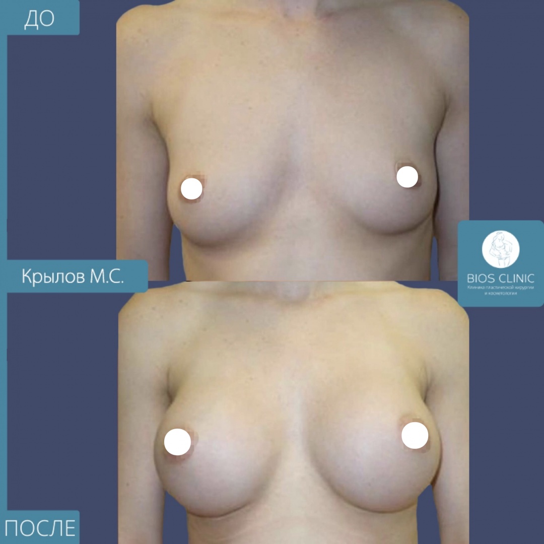 Увеличение груди круглыми имплантами, субмаммарный доступ фотография 1