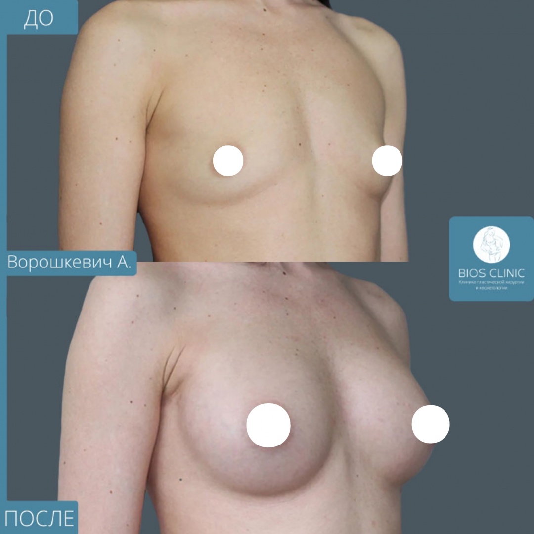 Увеличение груди эндоскопическим методом