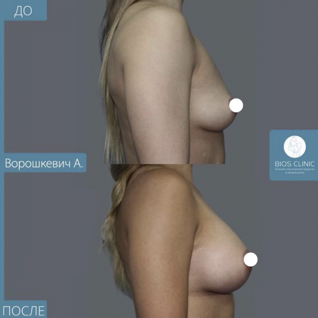 Увеличение груди через 2 месяца фотография 3