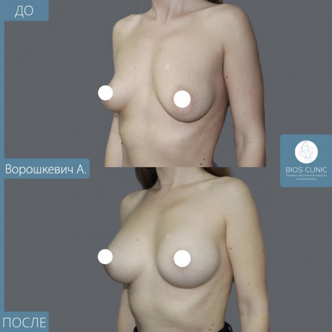 Увеличение груди с периареолярной подтяжкой фотография 2