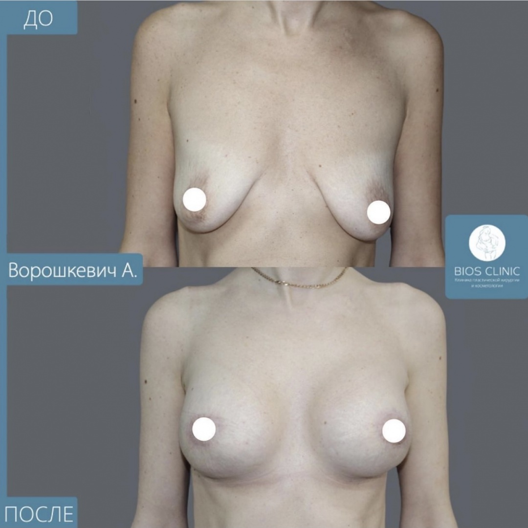 Увеличение груди + подтяжка по ареоле фотография 3