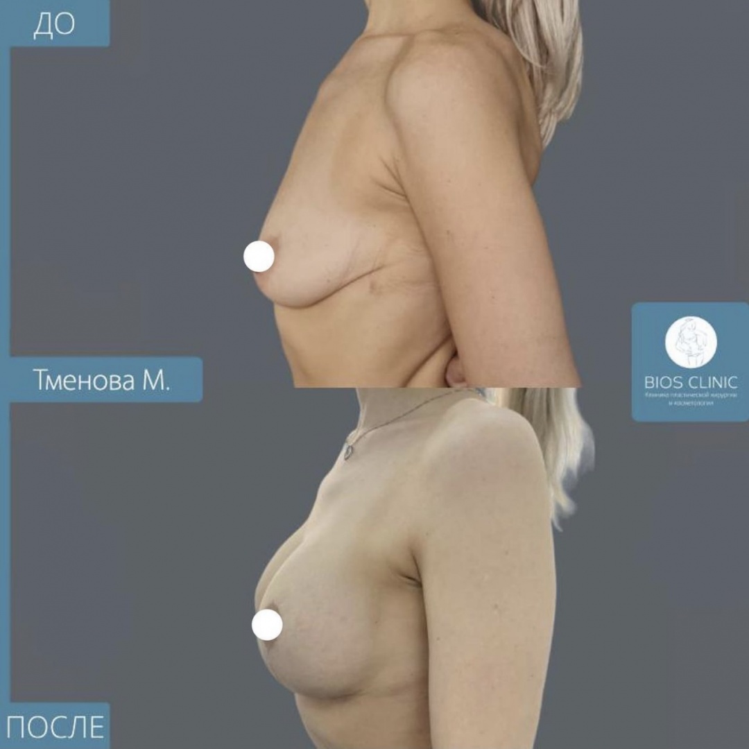 Увеличение груди + Т образная подтяжка фотография 3