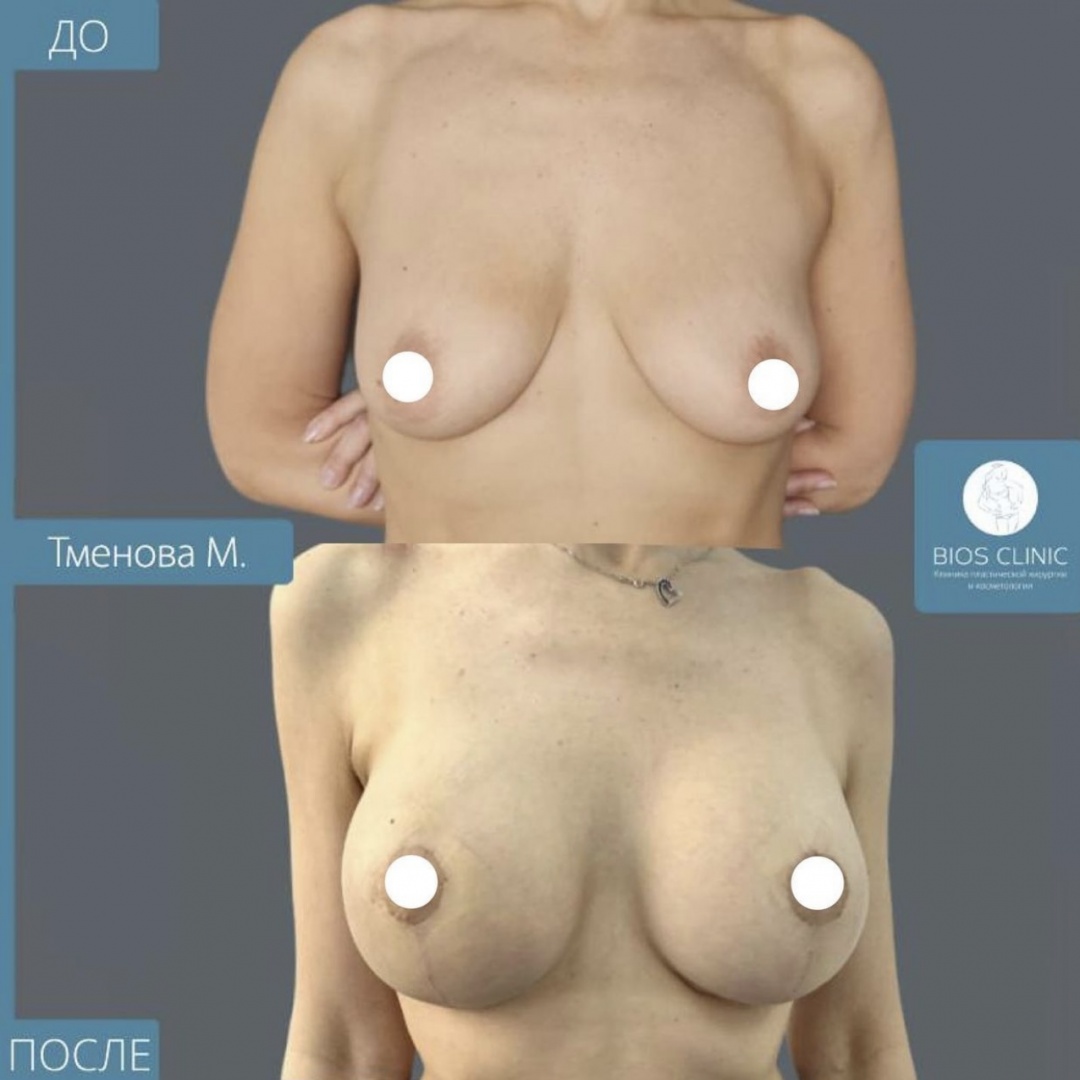 Увеличение груди + Т образная подтяжка фотография 2