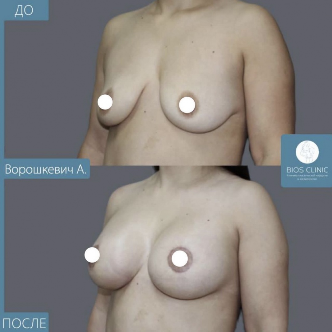 Увеличение груди с периареолярной подтяжкой фотография 2