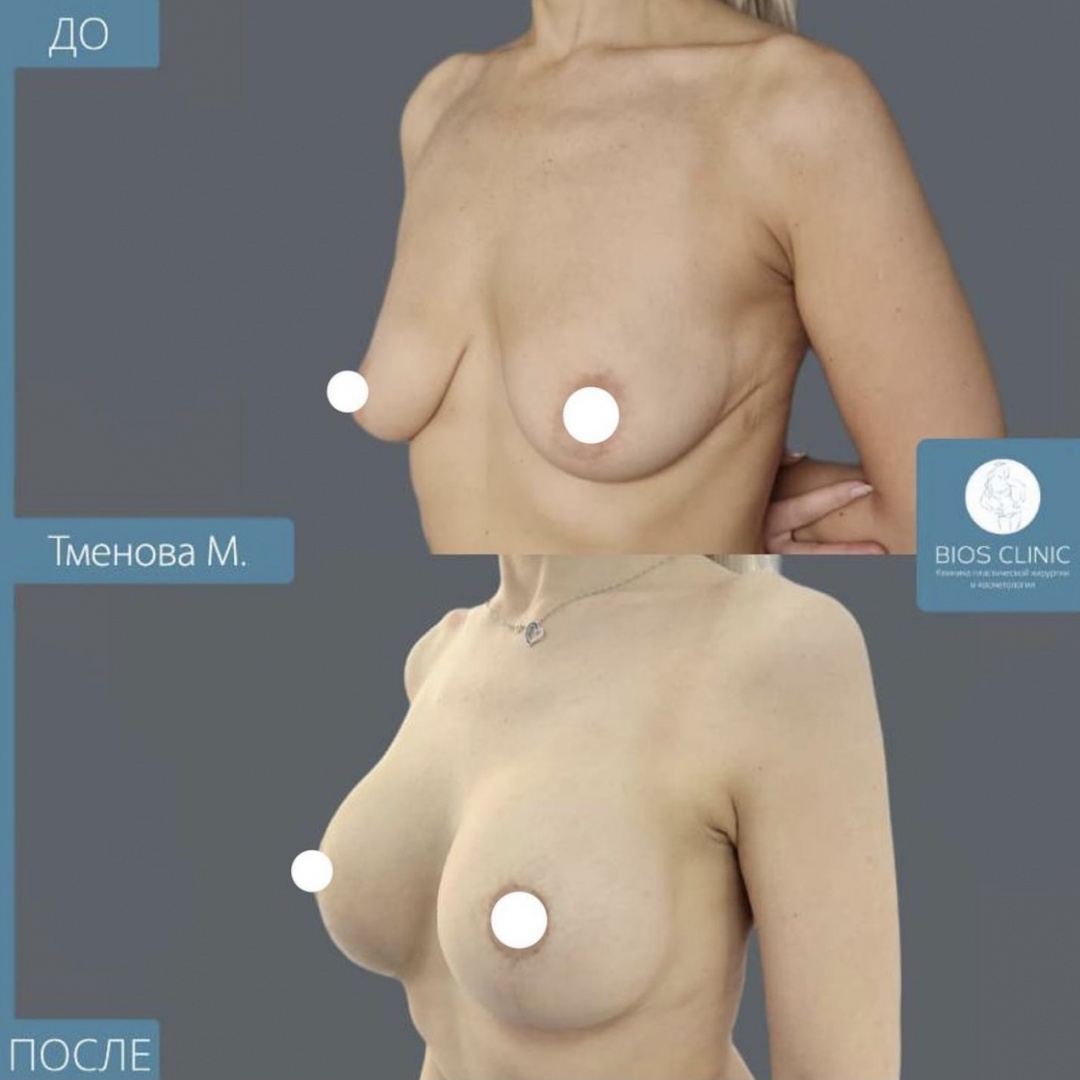 Увеличение груди + Т образная подтяжка фотография 1