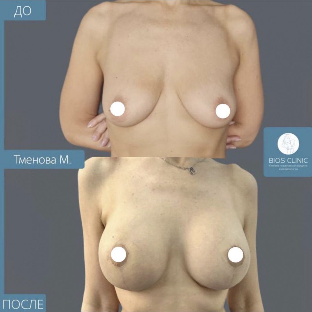 Подтяжка груди Т образная фотография 2